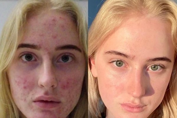 Stephen Lashbrook Psoriasis Ausheilung nach Löwen-Diät